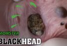 Monster Blackhead Removal | Acne Treatment