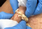 You’ve GOT to see this super infected cyst removal